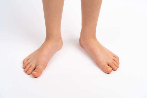 flat feet in children