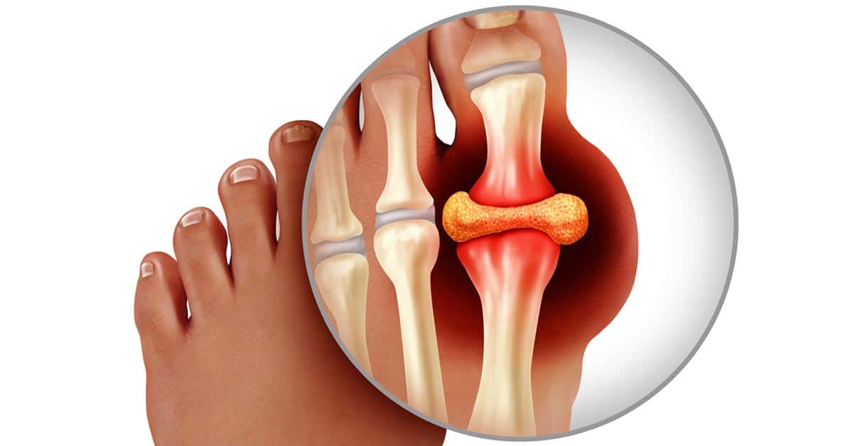 big-toe-joint-pain